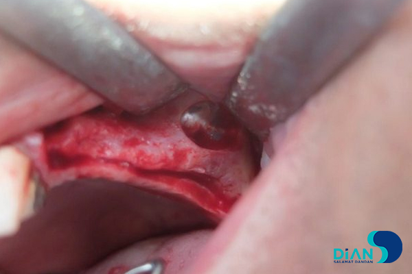 Sinus Lifting and Implantation