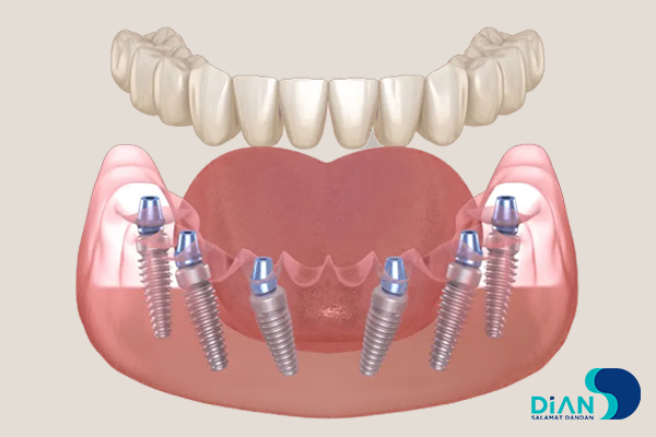 اباتمنت مولتی یونیت