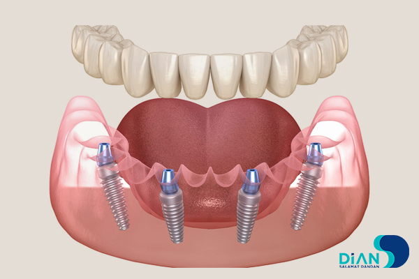 اباتمنت مولتی یونیت