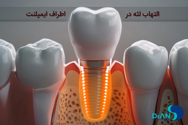 التهاب لثه اطراف ایمپلنت